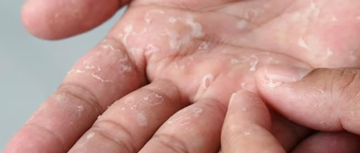 Шелушение кожи на руках